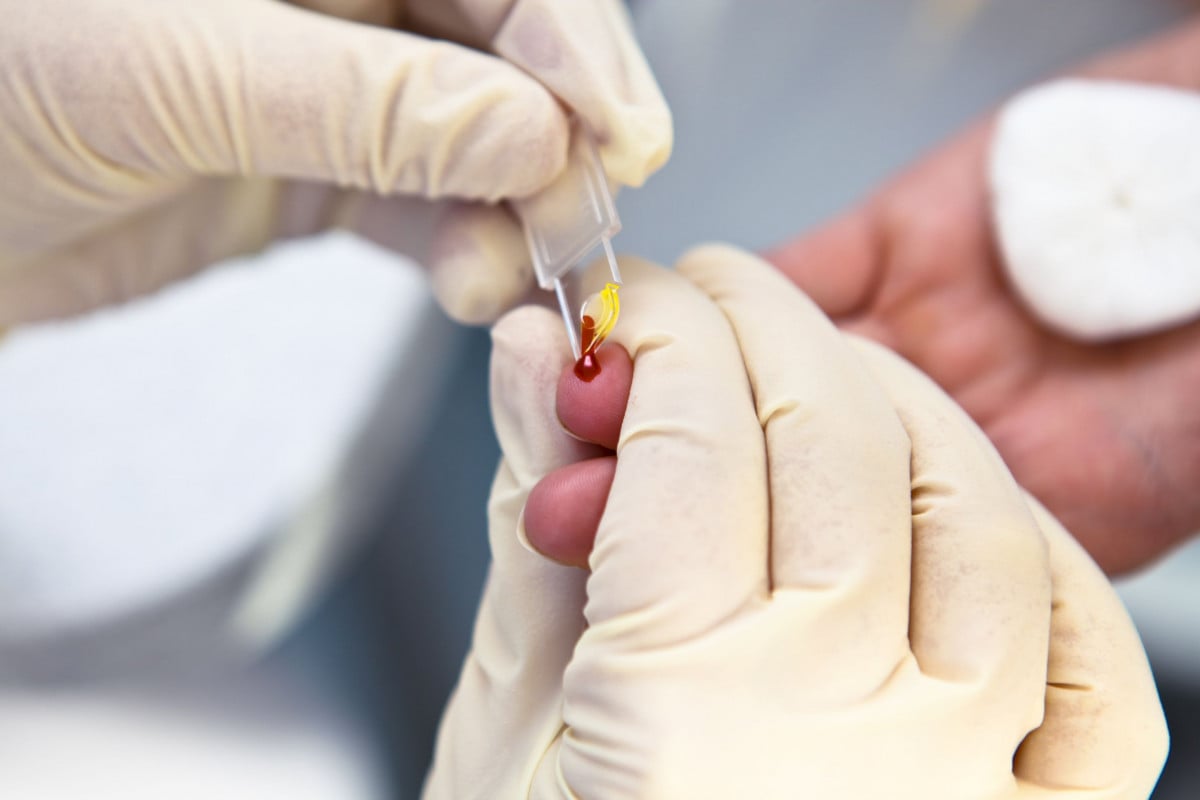 Pensione d'invalidità per i malati di AIDS